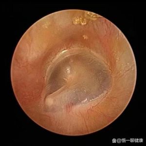 膜打鼓耳鸣揭秘_成因对策，告别烦扰噪音！