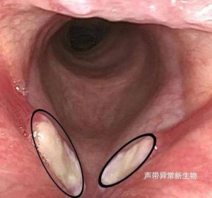 男性嗓音沙哑原因及防治全解析