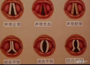 声带薄适合哪种音域_嗓子薄的人适合唱高音，技巧训练很重要，多练习扩大音域